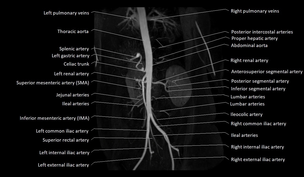 MRA abdomen (renal and mesenteric) angiography MIP 3D anatomy image 9.webp